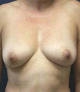 Breast Augmentation With Lift Before & After