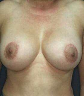 Breast Augmentation With Lift Before & After