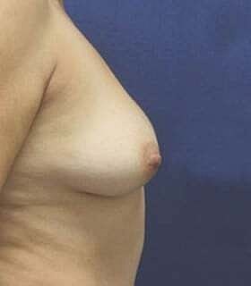 Breast Augmentation With Lift Before & After