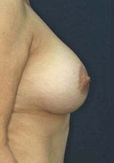 Breast Augmentation With Lift Before & After