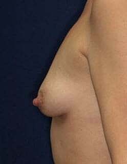 Breast Augmentation With Lift Before & After