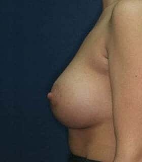 Breast Augmentation With Lift Before & After