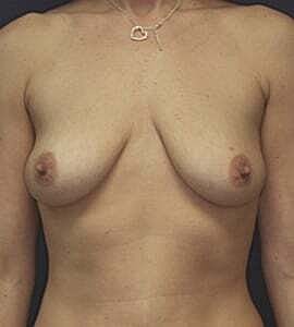 Breast Augmentation With Lift Before & After