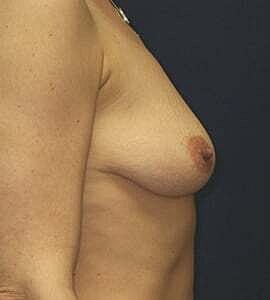 Breast Augmentation With Lift Before & After
