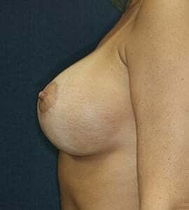 Breast Augmentation With Lift Before & After
