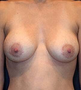 Breast Augmentation With Lift Before & After