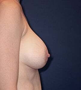 Breast Augmentation With Lift Before & After