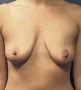 Breast Augmentation With Lift Before & After