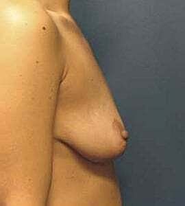 Breast Augmentation With Lift Before & After
