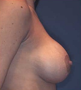 Breast Augmentation With Lift Before & After