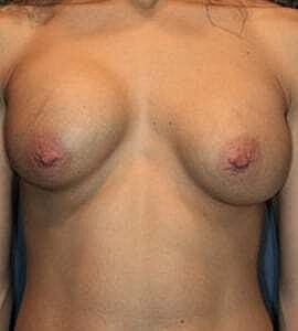Breast Augmentation With Lift Before & After
