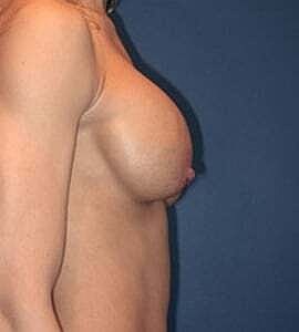 Breast Augmentation With Lift Before & After