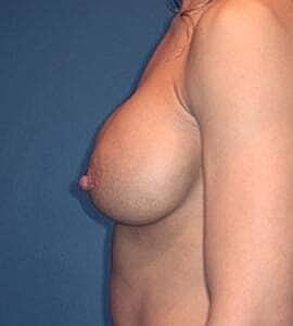 Breast Augmentation With Lift Before & After