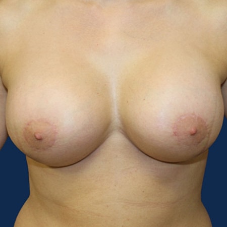 Breast Augmentation With Lift Before & After