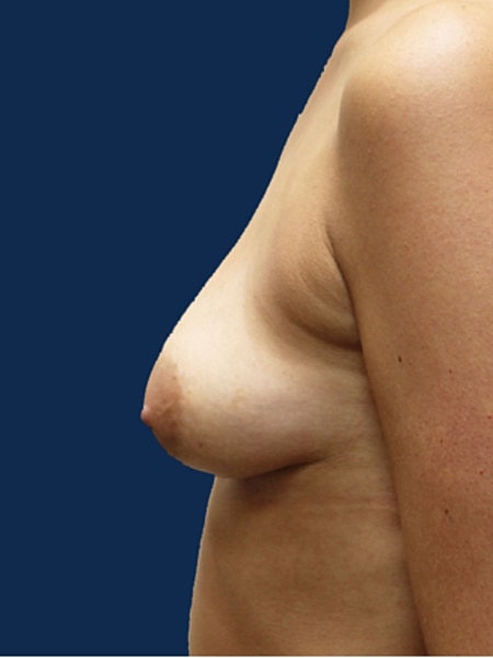 Breast Augmentation With Lift Before & After