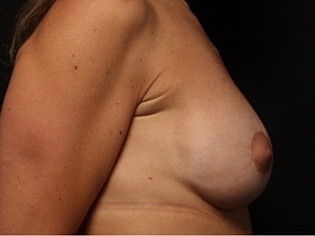Breast Augmentation With Lift Before & After