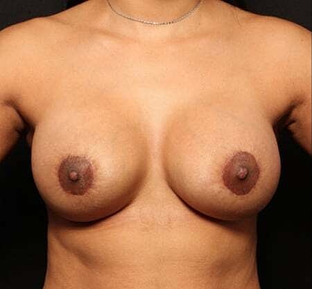 Breast Augmentation With Lift Before & After