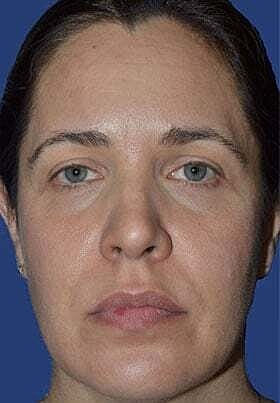 Facial Fillers Before & After