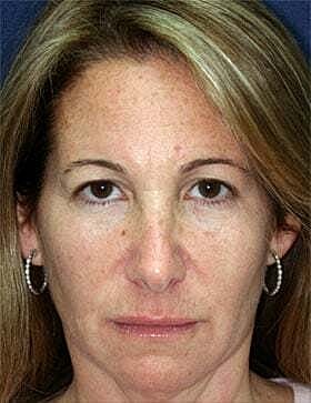 Facial Fillers Before & After