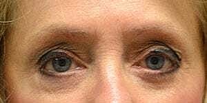 Facial Fillers Before & After