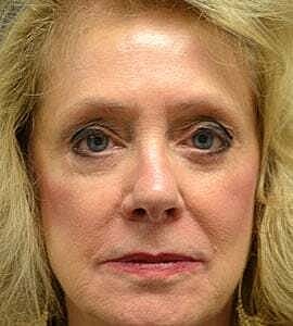 Facial Fillers Before & After