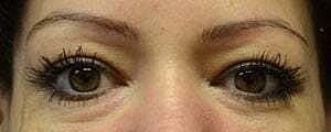 Facial Fillers Before & After