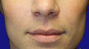 Facial Fillers Before & After