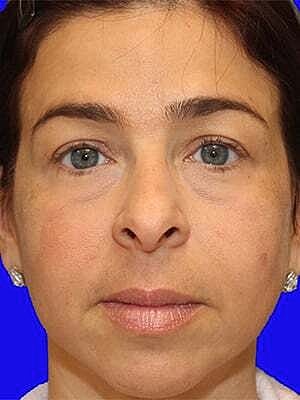 Facial Fillers Before & After