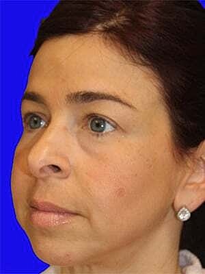Facial Fillers Before & After