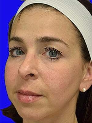 Facial Fillers Before & After