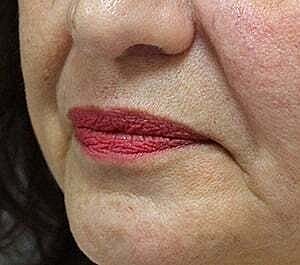 Facial Fillers Before & After