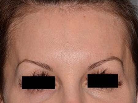 Facial Fillers Before & After