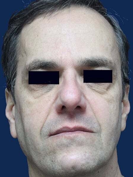 Facial Fillers Before & After