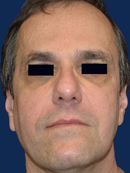 Facial Fillers Before & After