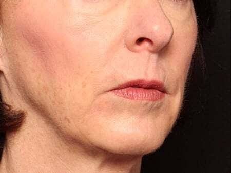Facial Fillers Before & After