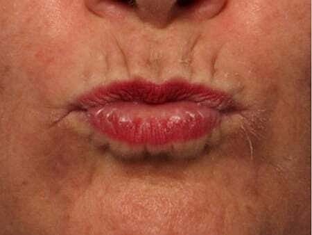 Facial Fillers Before & After