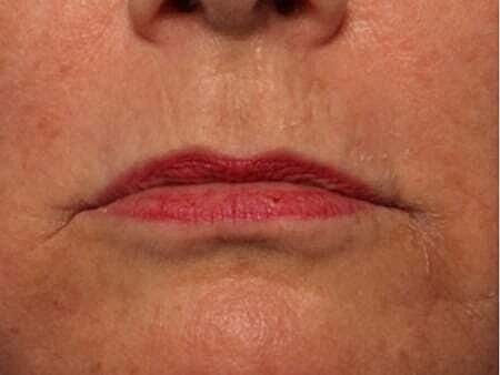 Facial Fillers Before & After