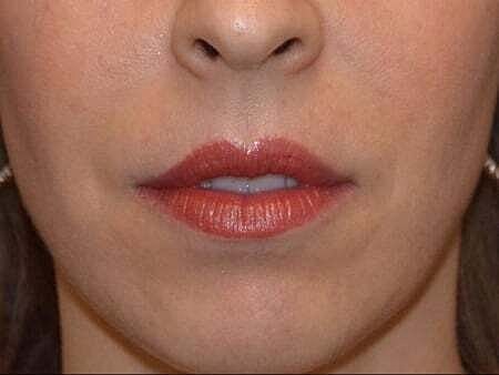 Facial Fillers Before & After