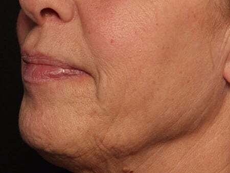 Facial Fillers Before & After