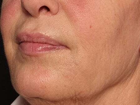 Facial Fillers Before & After