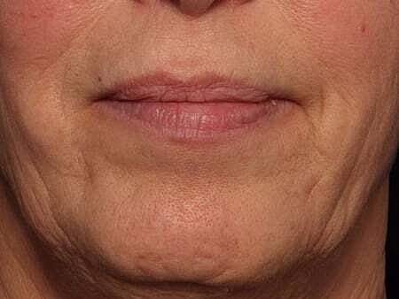 Facial Fillers Before & After