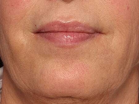 Facial Fillers Before & After