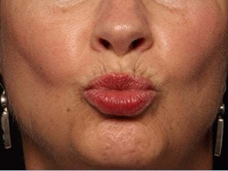 Facial Fillers Before & After