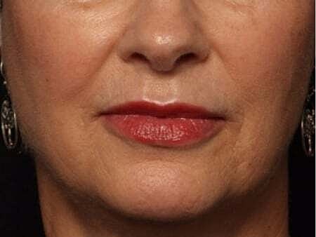 Facial Fillers Before & After
