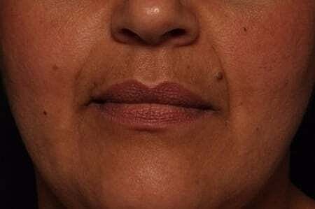 Facial Fillers Before & After