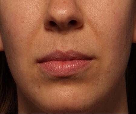 Facial Fillers Before & After