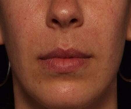 Facial Fillers Before & After