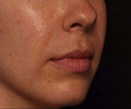 Facial Fillers Before & After