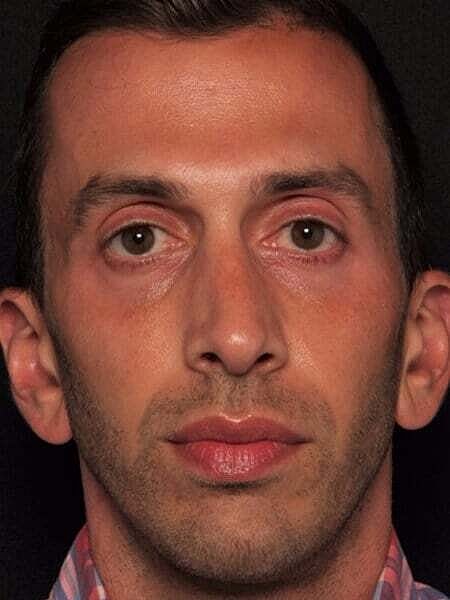 Facial Fillers Before & After