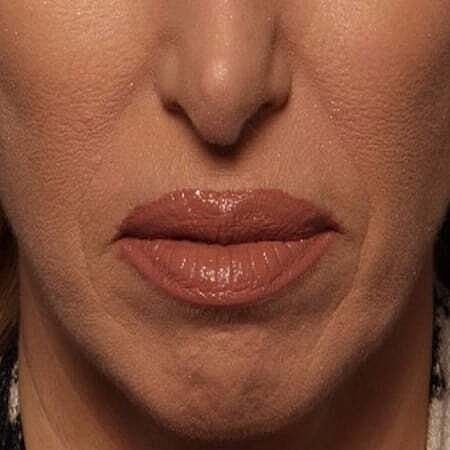 Facial Fillers Before & After